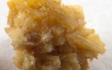Kidney stone. A team from the University of Houston led by Jeffrey Rimer has discovered a new molecule with the potential to be a more effective inhibitor of kidney stone formation.