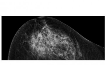 This mammogram depicts breast bearing malignant tumor.