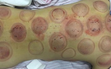 Pictures from Xu Ting's Sina Weibo social media account show the aftermath of a cupping session.