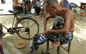 A recovering leper in a leprosy village shows off his injuries.