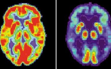 healthy brain (L) and Alzheimer's brain (R)