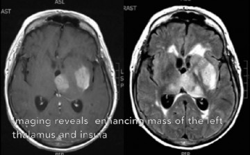 High-grade glioma