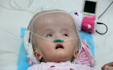 Three-year-old Han Han was diagnosed with congenital hydrocephalus.