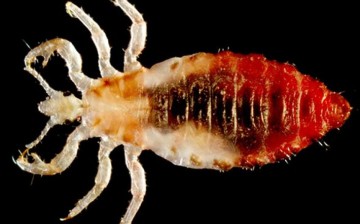 head lice