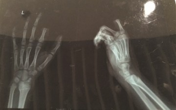X-ray of Xiaopeng