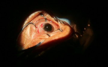 Cataract Patients Undergo Eye Surgery On Lifeline Express
