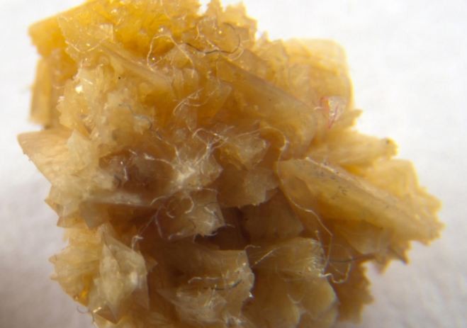 Kidney stone. A team from the University of Houston led by Jeffrey Rimer has discovered a new molecule with the potential to be a more effective inhibitor of kidney stone formation.