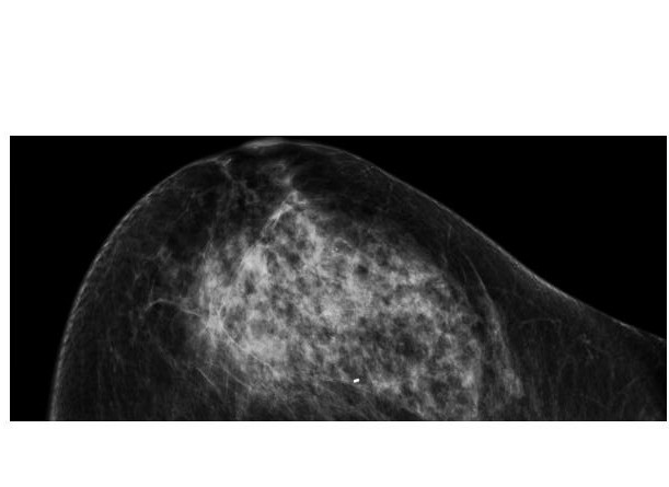 This mammogram depicts breast bearing malignant tumor.