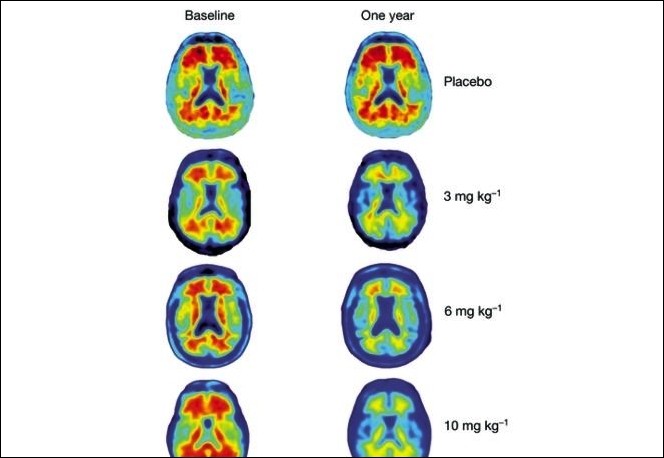 PET images of Alzheimer’s patients receiving aducanumab showing amyloid plaque reduction after one year. 