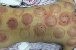 Pictures from Xu Ting's Sina Weibo social media account show the aftermath of a cupping session.