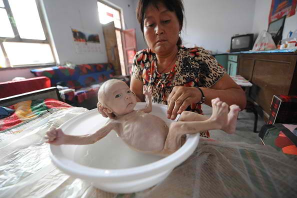 More children with birth defects are born in China.