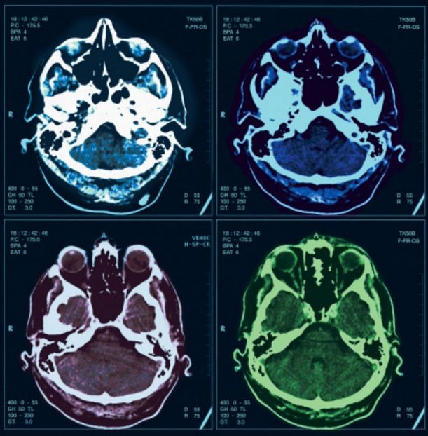 CAT scan images of the human brain.