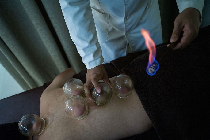 Undergoing Traditional Cupping Treatment In Hong Kong
