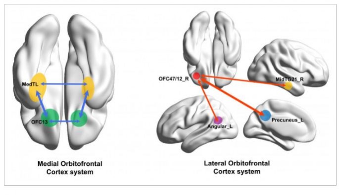 The human medial (reward-related, OFC13) and lateral (non-reward-related, OFC47/12) orbitofrontal cortex networks that show different functional connectivity in patients with depression.