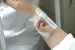 Chinese doctors grow an ear for transplant on a patient's arm.