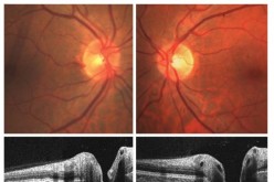 Before-and-after images of an astronaut’s eyes via spectral domain optical coherence tomography show choroidal folds (marked by arrows), which are similar to stretch marks.        