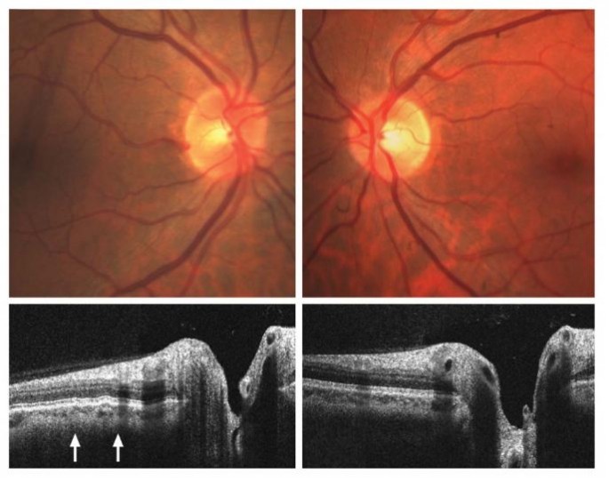 Before-and-after images of an astronaut’s eyes via spectral domain optical coherence tomography show choroidal folds (marked by arrows), which are similar to stretch marks.        