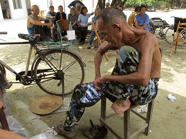 A recovering leper in a leprosy village shows off his injuries.