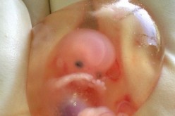 Silas Phillips, born inside intact amniotic sac