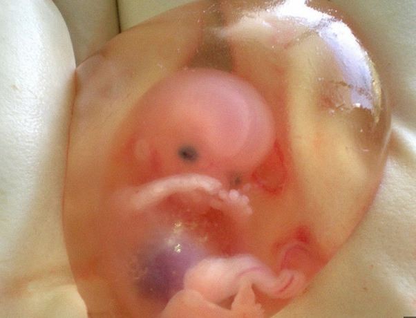 Silas Phillips, born inside intact amniotic sac