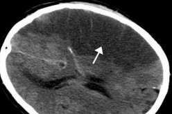 Right-hemispheric ischemic stroke revealed in a CT scan of the brain.