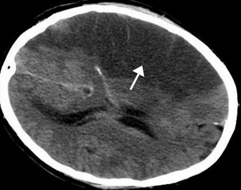 Right-hemispheric ischemic stroke revealed in a CT scan of the brain.