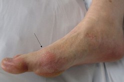 Gout in the metatarsal-phalangeal joint of the big toe as seen in the slight redness of the skin overlying the joint.