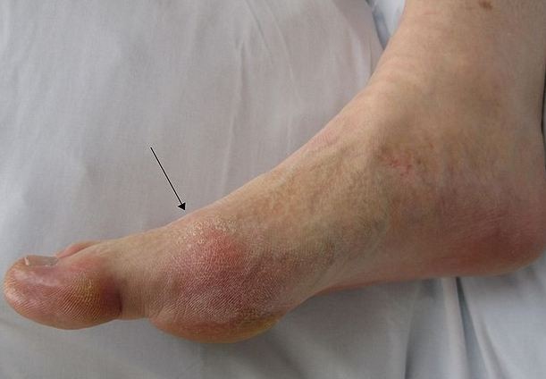 Gout in the metatarsal-phalangeal joint of the big toe as seen in the slight redness of the skin overlying the joint.