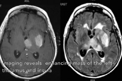 High-grade glioma