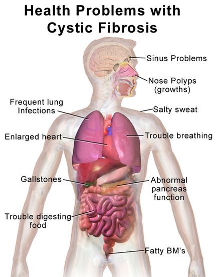 Health problems caused by cystic fibrosis