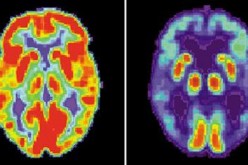 PET scans of healthy brain (L), dementia brain (R)