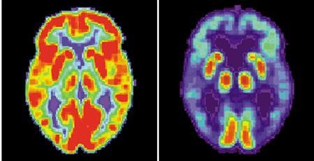 PET scans of healthy brain (L), dementia brain (R)