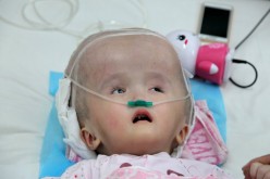 Three-year-old Han Han was diagnosed with congenital hydrocephalus.