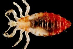 head lice