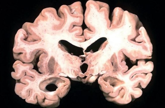 Alzheimer’s disease accounts for 60 to 80 percent of dementia cases, according to Alzheimer’s Association. 