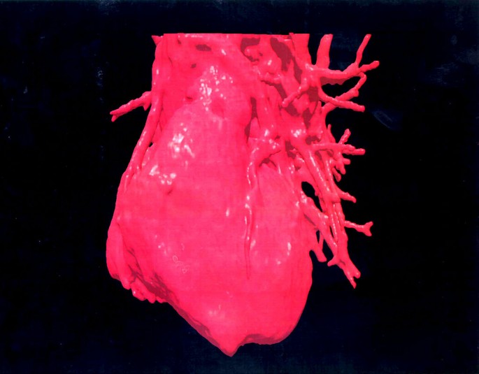 Three Dimensional (3 D Image Displays A Computerised Visualization Of A Human Heart