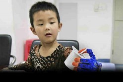 Previously, Chinese doctors used 3D printing technology to provide a boy in Wuhan with a 3D-printed prosthetic hand.