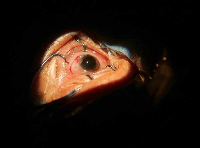 Cataract Patients Undergo Eye Surgery On Lifeline Express